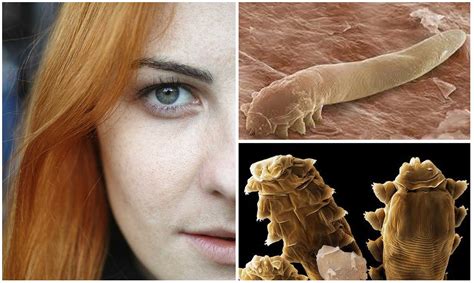 Como matar ácaros Demodex